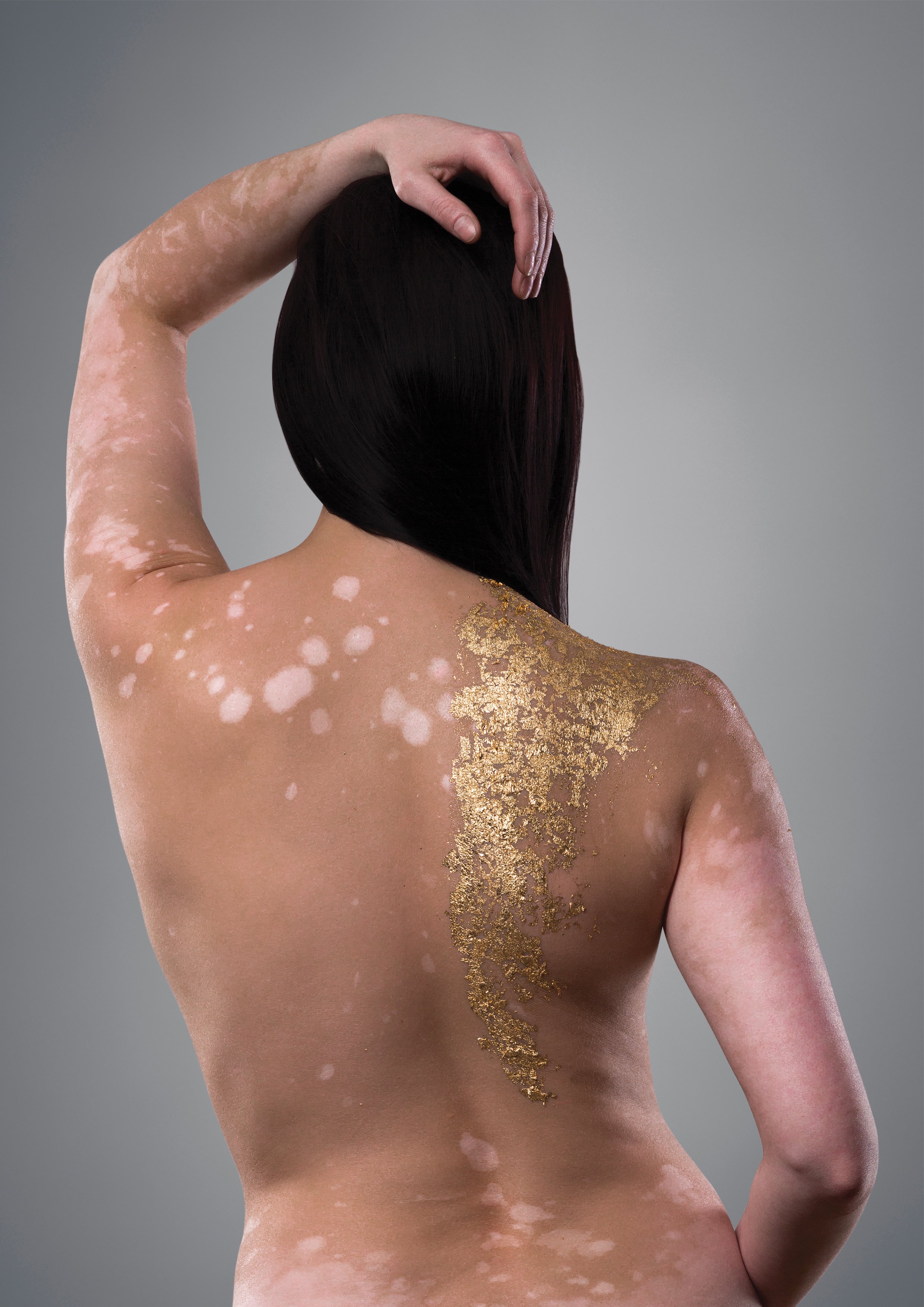 Vitiligo I.