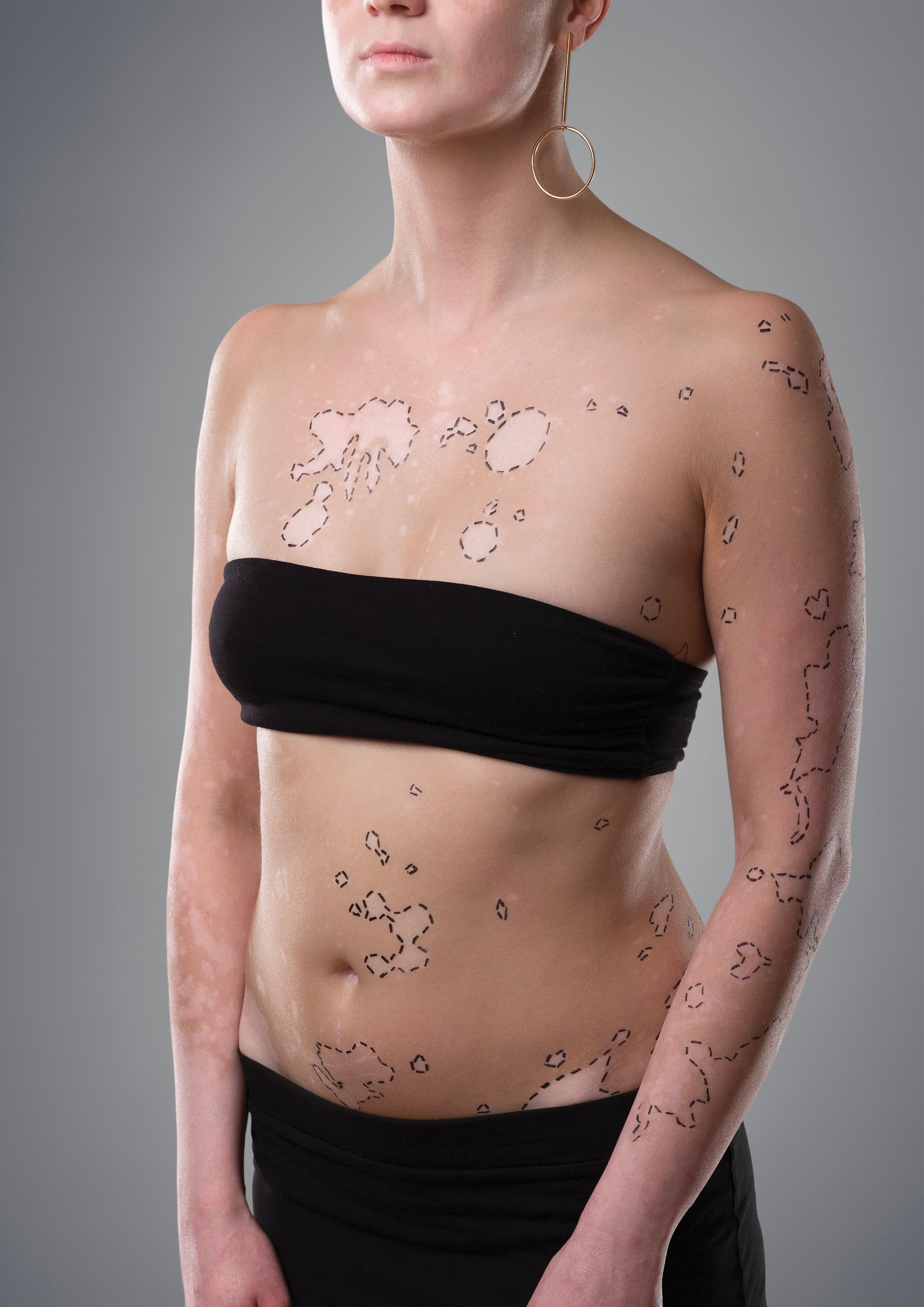 Vitiligo II.